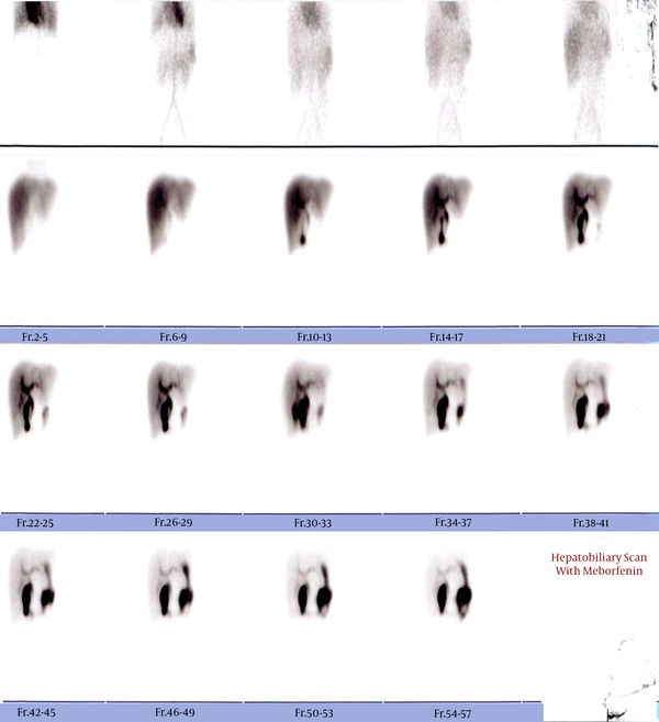 Hepatobiliary scintigraphy with fatty meal ingestion. Gallbladder is seen with an unusual lobulated shape. Distension and retention of activity are seen even four hours after fatty meal consumption.