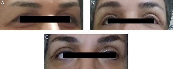 A, Before the blepharoplasty; B, 5 days after blepharoplasty; C, 7 days after blepharoplasty are shown.