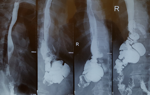 Barium study 3 months after operation in esophagoileostomy anastomosis with a circular stapler.