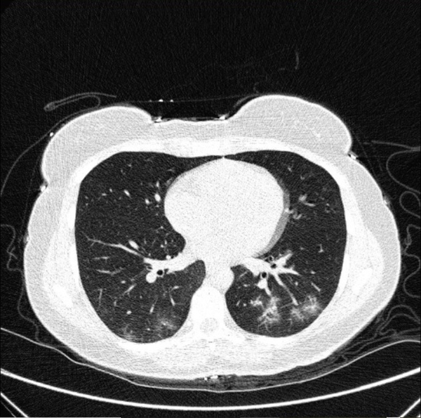 Typical CT imaging features of COVID-19. Unenhanced thin-section axial image of the lungs in a patient with a positive RT-PCR result shows multifocal ground glass opacity (GGO) with rounded morphology, with or without consolidation or a crazy paving pattern.