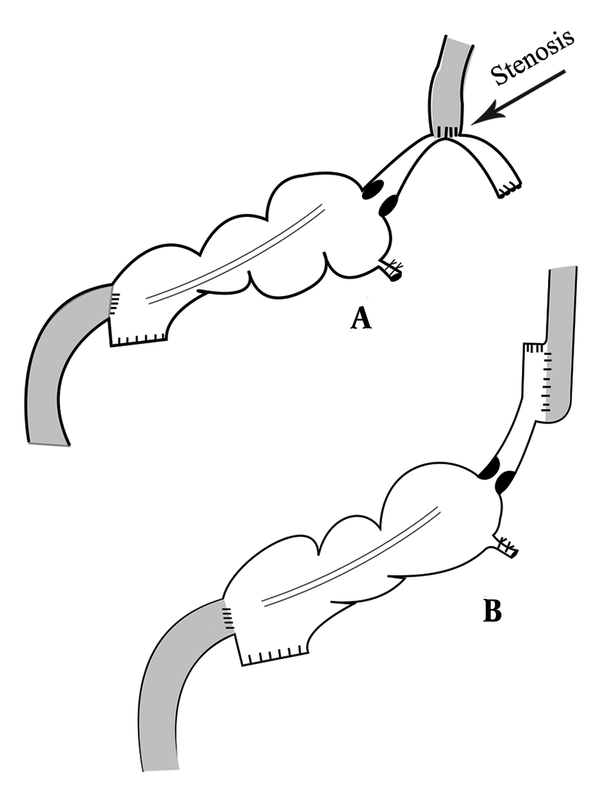 Esophagoileostomy anastomosis with a circular stapler (A) and side to side GIA stapler (B).