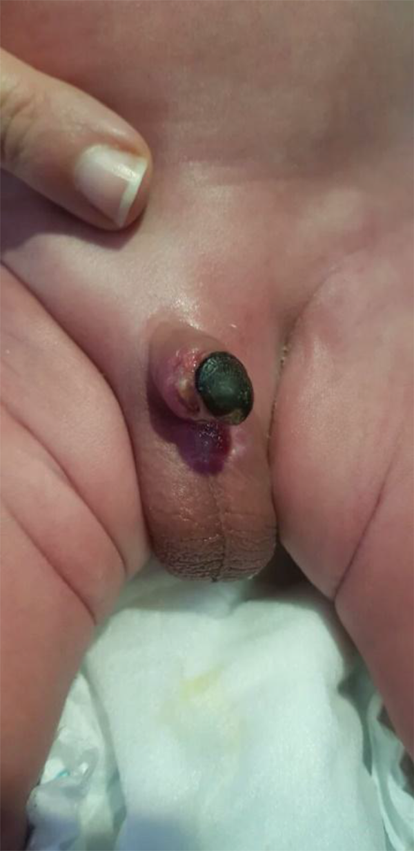 I have a few issues with my penis after circumcision. What to do?