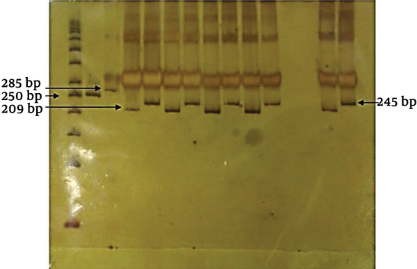 PCR-RFLP results of patients with MM genotypes. PCR products were digested by Taq I and separated on 10% Polyacrylamide gel electrophoresis (PAGE). (1) 50 bps ladder, (2) Undigested Z allele product (250 bp), (3) Undigested S allele product (285 bp), (4) Non-mutated PCR-Z allele (209 bp), 5) Non-mutated PCR-S allele (245 bp).