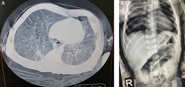Different image modalities from case 4: A, Axial slice of chest CT scan at admission time revealing two-sided ground-glass opacity and crazy paving pattern; B, abdominal X-ray showing a coffee-bean view.
