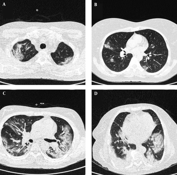 Typical CT imaging features of COVID-19. Unenhanced thin-section axial image of the lungs in a patient with a positive RT-PCR result (A-D) shows peripheral and multifocal ground glass opacity (GGO) with consolidation.