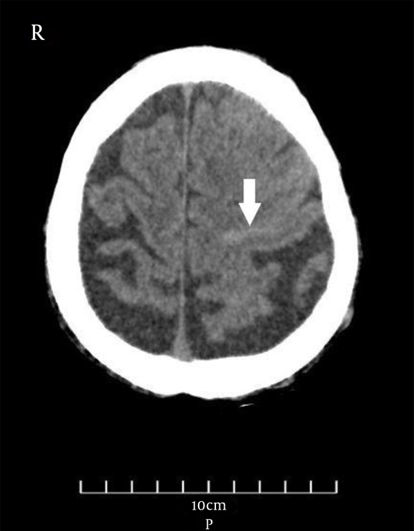 Non-enhanced computer tomography of the brain shows subtle SAH at the high left frontal convexity region (white arrow).