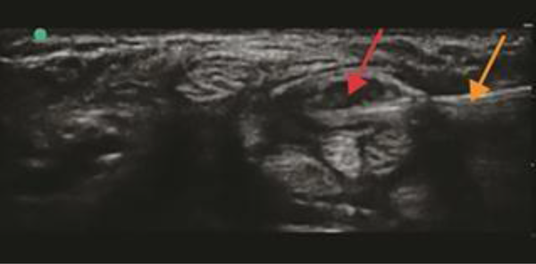 Sonar-guided image illustrating median nerve (red arrow) and needle position (orange arrow) inferior to median nerve