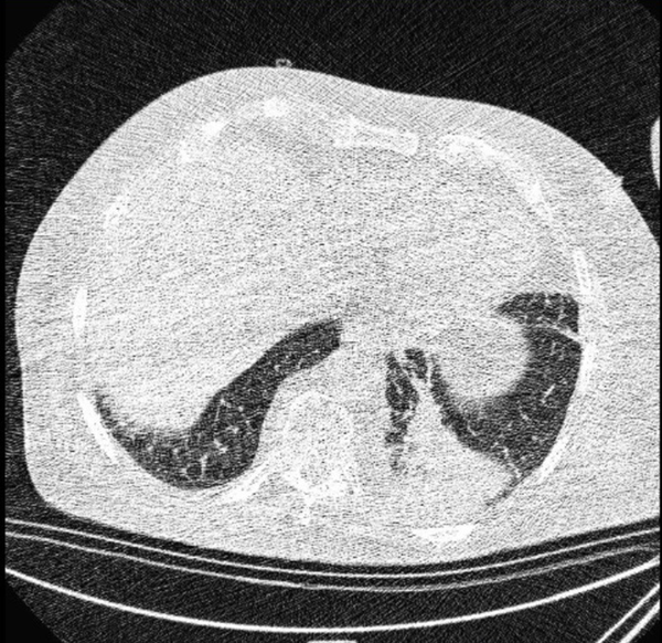 Atypical CT imaging features of COVID-19. Unenhanced thin-section axial image of the lungs in a patient with a positive RT-PCR shows segmental consolidation without ground glass opacity (GGO).