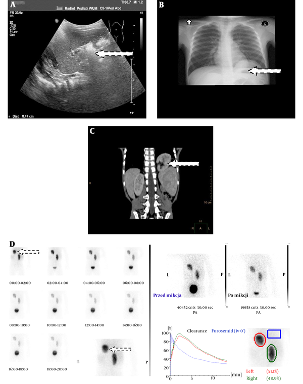 Case 1 (male): A, Ultrasonography of the left kidney above the spleen (spleen between the calipers); B, Posterior-anterior (PA) chest radiograph shows a mass above the left hemidiaphragm; C, Coronal CT scan shows the left kidney in the left posterior-interior thorax; D, 99mTc-ethylene-dicysteine (99mTc-EC) renal scintigraphy (PA).