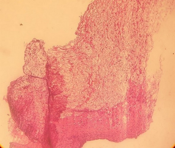 Benign fibromyxoid tumor compatible with Cardiac Myxoma. Microscopic sections (stained by H & E method) showed a benign hypocellular neoplastic tissue. Neoplastic cells consisted of some smooth muscle cells, spindle cells, a few stellate cells, and foci of hemorrhage.