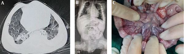 Images from case 1: A, Axial slice of chest CT scan at admission time showing two-sided ground-glass opacity and crazy paving pattern; B, abdominal X-ray showing a coffee-bean view in the left upper quadrant; C, several large lymph nodes in the peritoneum during laparotomy.