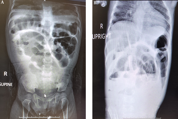 Plain abdominal X-ray. A, Supine abdominal X-ray; and B, upright X-ray revealed small intestine distention with air-fluid levels.