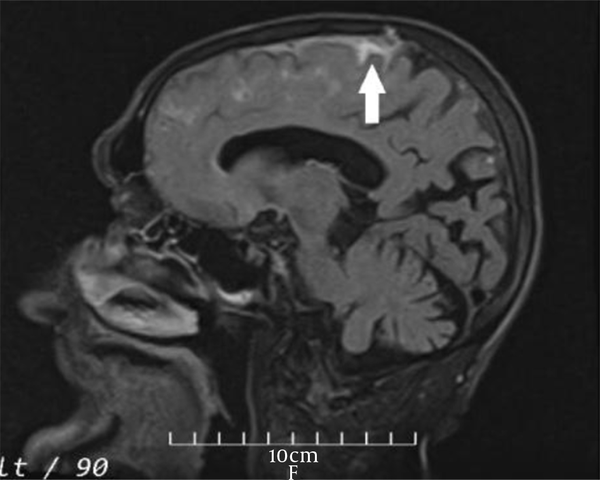 Brain MRI (FLAIR sequence) parasagittal plane image shows hyperintensity in the subarachnoid spaces of the high left frontal convexity region in agreement withhemorrhage (white arrow).