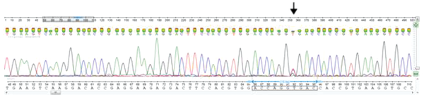 Sequence chromatograms of a T to C missense mutation at position 710 (Val237Ala) in the SERPINA1 gene. The arrow shows the sequence change.
