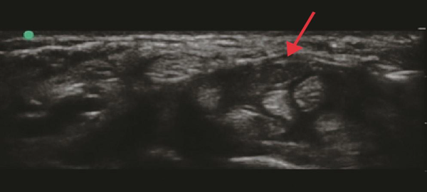 Sonar-guided image showing median nerve (red arrow)