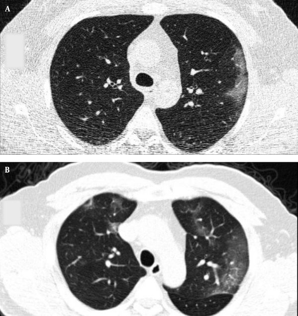Typical CT imaging features of COVID-19. Unenhanced thin-section axial image of the lungs in a patient with a positive RT-PCR shows peripheral ground glass opacity (GGO), with or without consolidation or visible intralobular lines (crazy paving pattern).