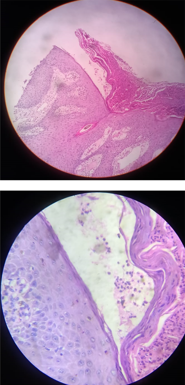 Epidermis shows hyperkeratosis with pointed rete ridges, at places, shows verrucous hyperplasia. Intraepidermal suprabasal clefts filled with polymorphonuclear cells, eosinophils, and few acantholytic epidermal cells.