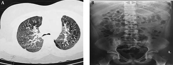 Two different image modalities from case 2: A, Axial slice of chest CT scan at admission time showing two-sided ground-glass opacity confirming COVID-19 pneumonia; B, no abnormal finding was observed in abdominal X-ray.