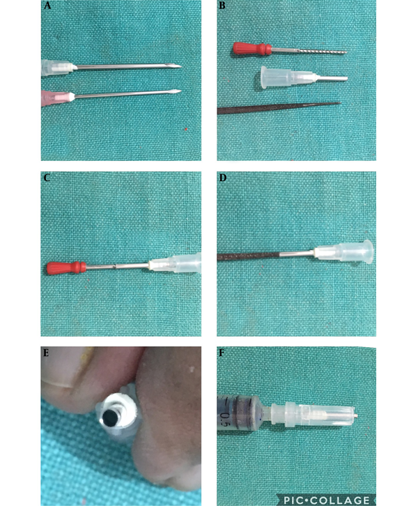 A, The 16 and 18 G needle for procuring needle punch; B-D, The needle is broken and sharpen with dental burr and conical mini file; E, The needle is ready for punching the lesion; F, The hypodermic needle punch guarded with its cap