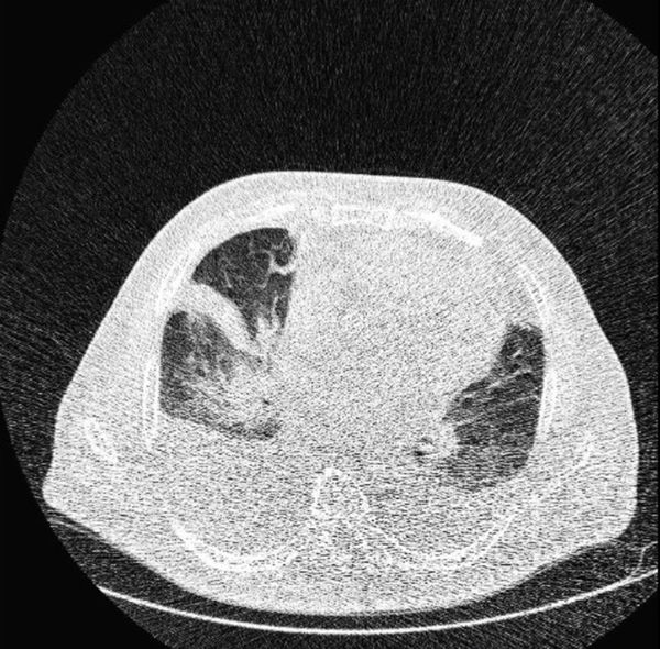 Atypical CT imaging features of COVID-19. Unenhanced thin-section axial image of the lungs in a patient with a positive RT-PCR result shows consolidation without ground glass opacity (GGO) and bilateral pleural effusion.