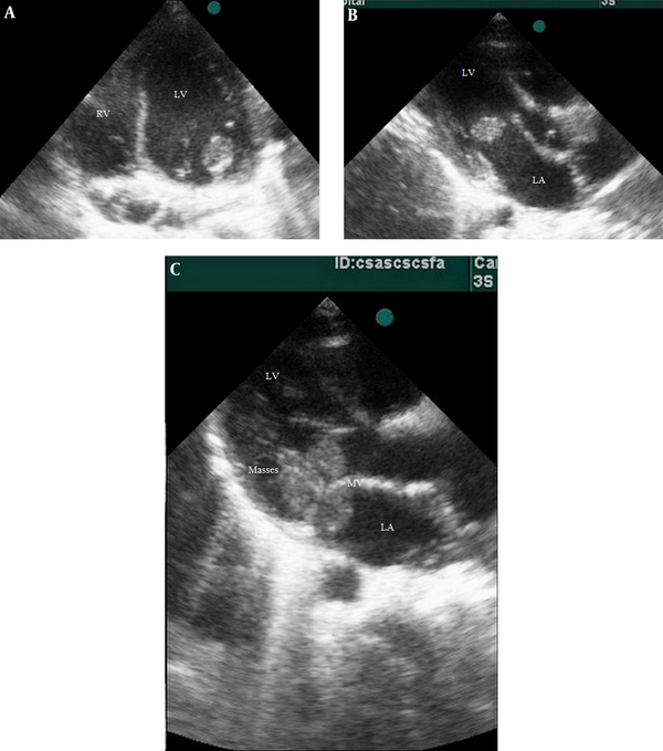 Transthoracic 2D echocardiography showed three mobile masses considered vegetation in the left atrium (LA) around mitral valve (MV) apparatus. A: Apical four-chamber view. B, C: Parasternal long-axis view. LV, left ventricle; RV, right ventricle.