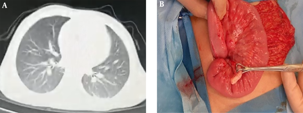 Two different images from case 3: A, Axial slice of chest CT scan at admission time revealing two-sided ground glass-opacity due to COVID-19 pneumonia; B, several large lymph nodes in the peritoneum during appendectomy.
