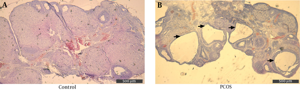 DHEA-injection induces cystically dilated ovarian follicles. H&amp;E stain of the ovaries of (A) the control rats and of (B) the DHEA-induced PCOS rats under 40X magnification (scale bar = 500 μm). Arrows indicate the abnormally dilated follicles with thickened granulosa.