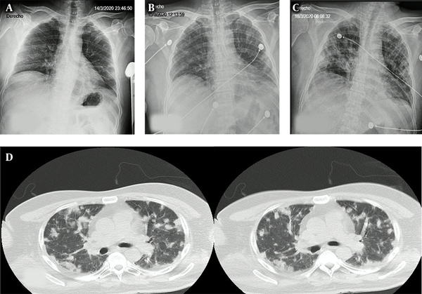 A, chest X-Rey at admission with interstitial infiltrates; B, chest X-Rey with accentuation of interstitial infiltrates; C, chest X-Rey at ICU admission with new bilateral alveolar infiltrates; D, chest CT with nodular bilateral infiltrates, along with areas of consolidation.