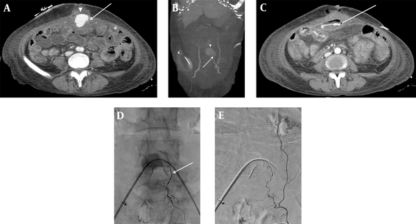 Contrast-enhanced abdominal CT (A) axial image and (B) maximum intensity projection (MIP) image demonstrate acute hematoma (arrowhead) in the paramedian anterior abdominal wall, arising from the left inferior epigastric artery (IEA) (arrow). (C) The contrast medium is extravasated (line) into the adjacent jejunal lumen. The superselective left IEA angiogram (D) shows contrast pooling at the branch of the left IEA (arrow). The completion angiogram after coil embolization (E) shows the disappearance of contrast pooling.