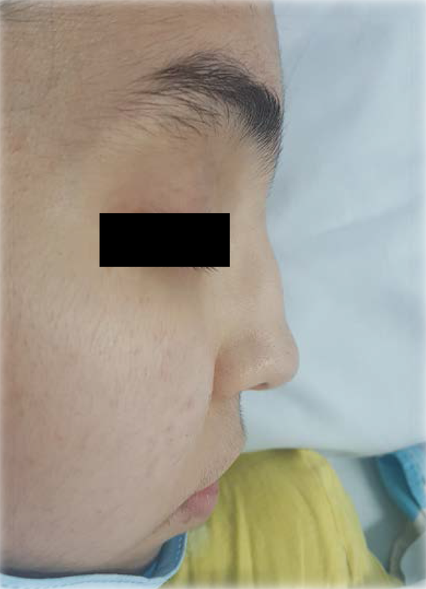 Patient's saddle nose deformity