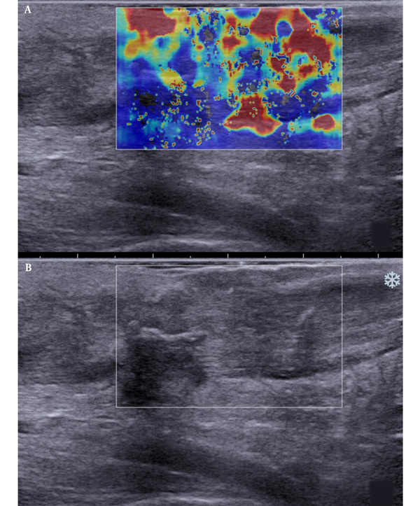 Longitudinal scans of a ruptured Achilles tendon one month after surgery. A, The shear wave elastography (SWE) image is characterized by red-and-yellow and blue colors. B, B-mode sonography shows that the tendon echostructure is heterogeneous.