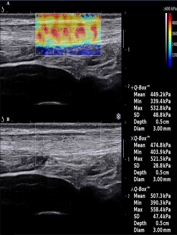 Longitudinal scans of a normal Achilles tendon (male, 32 years old). A, The shear wave elastography (SWE) image is characterized by red and yellow colors; B, B-mode sonography shows that the echo of the tendon is homogeneous.