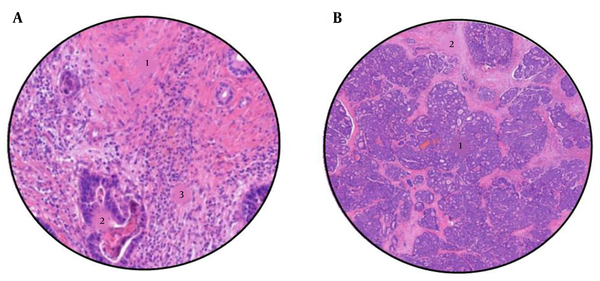 A, Sample from a colorectal liver metastases after neoadjuvant chemotherapy, with a tumour regression grade of 2 (TRG2). 1: Abundant fibrosis, 2: Few tumour cells, and 3: Lynphocytic infiltrate. B, Sample from a colorectal liver metastases after neoadjuvant chemotherapy, with a tumour regression grade of 5 (TRG5). 1: Abundant tumour cells, and 2: Areas of necrosis.