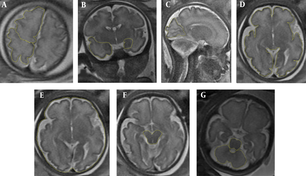 T2-weighted magnetic resonance images (MRI) demonstrate different brain lobe areas. A, Frontal and parietal lobe areas (in the axial plane, right above the cavum septum pellucidum and lateral ventricles); B, Temporal lobe and hippocampus areas (in the coronal plane, right anterior to the pons level); C, Occipital lobe area (in the first para-sagittal plane, near the falx, posterior to the parieto-occipital sulcus); D, Whole brain area (WBA) (in the axial plane, at the level of the cavum septum pellucidum); E, Whole intracranial area (at the same level of WBA by tracing the cursor inside the bony calvarium); F, Midbrain area; G, Cerebellum and pons areas (in the axial plane, at the level of the middle cerebellar peduncle).