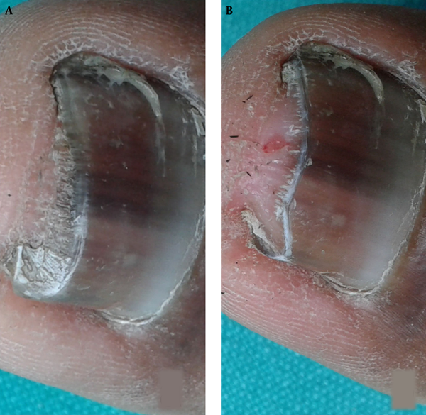 The chemically splinted ingrown nail and after resection of the distal free part of lateral nail showing the nail curvature and its embedding in the gutter of grade I stage ingrown toe nail.