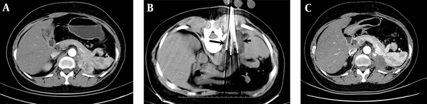 A 59-year-old man with left AM after lung squamous cell carcinoma (SCC) resection. (A) Contrast-enhanced CT images of a left adrenal metastasis (AM) exhibiting significant enhancement (arrow). (B) Cryoablation procedures. The cryoprobes (long arrow) were placed into the tumor, and the frozen area could be seen on the CT image (short arrow). (C) Contrast-enhanced CT scan, indicating no visible tumor enhancement after treatment (arrow).