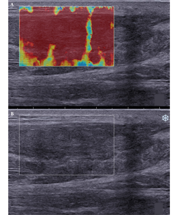 Longitudinal scans of a ruptured Achilles tendon of six months after surgery. A, The shear wave elastography (SWE) image is almost completely red; B, B-mode sonography shows that the tendon echostructure is heterogeneous (^: fiber cord structure).