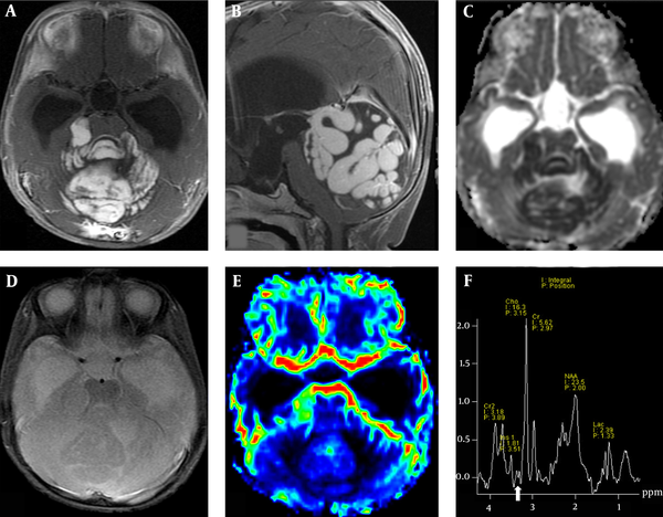 The MRI study of a nine-month-old female patient with an enlarging head circumference and delayed motor milestones. Axial (A) and sagittal (B) post-contrast enhanced T1WI images show an enhanced mass with a striking gyriform pattern in the posterior cranial fossa. The ADC map shows diffusion restriction in the lesion (C). No hemorrhage or calcification in SWI (D) and no increased rCBV on DSC perfusion image (E) are observed. (F) MR spectroscopy shows an elevated Cho peak, decreased NAA, and low concentrations of Tau (arrow). Abbreviations: ADC: Apparent diffusion coefficient; SWI, Susceptibility-weighted imaging; rCBV, Relative cerebral blood volume; DSC, Dynamic susceptibility contrast; Cho, Choline; NAA, N-acetyl aspartate; Tau, Taurine.