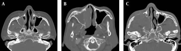 Assessment of adjacent bone destruction. A, A patient with extramedullary plasmacytoma (EMP) shows no bone destruction in the right maxillary sinus wall; B, A patient with non-Hodgkin’s lymphoma (NHL) shows an erosive change of the right maxillary sinus wall; C, Bone destruction is seen in the right maxillary sinus walls in a patient with squamous cell carcinoma (SCC).