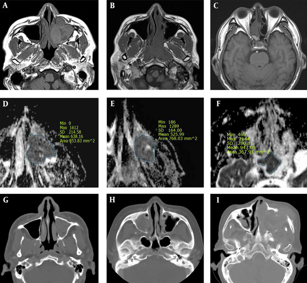 A comparative analysis of sinonasal extramedullary plasmacytoma (EMP) (A, D, and G), non-Hodgkin’s lymphoma (NHL) (B, E, and H) and squamous cell carcinoma (SCC) (C, F, and I). EMP shows a higher heterogeneity on T1W images as compared to NHL, besides lower ADCs and less adjacent bone destruction as compared to SCC. A, B, and C, Axial T1W MR images; D, E, and F, Axial ADC maps; and G, H, and I, CT images.