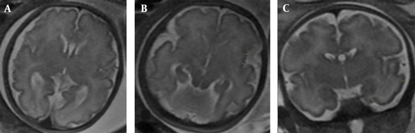 T2-weighted magnetic resonance images (MRI) show the brain cortical thickness assessment. A, Frontal and occipital lobe cortical thickness measurements (in the axial plane, at the level of the cavum septum pellucidum); B, Insular cortical thickness measurements (in the axial plane, right below the plane of the cavum septum pellucidum); C, Temporal lobe cortical thickness measurement (in the coronal plane, just anterior cut to the pons level). The two parts were measured from the inner side to the outer side.