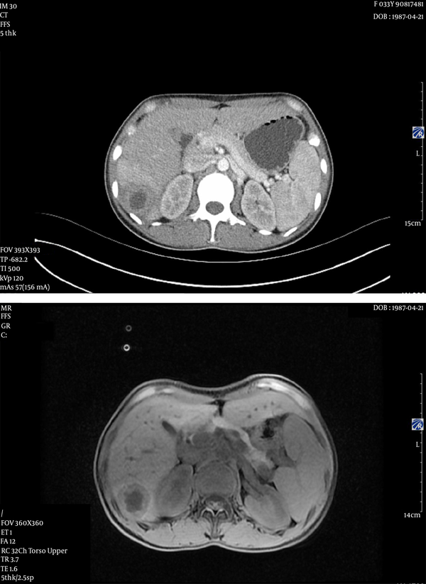 A, abdominal CT; and B, MRI indicating an abscess in the right lobe of the liver.