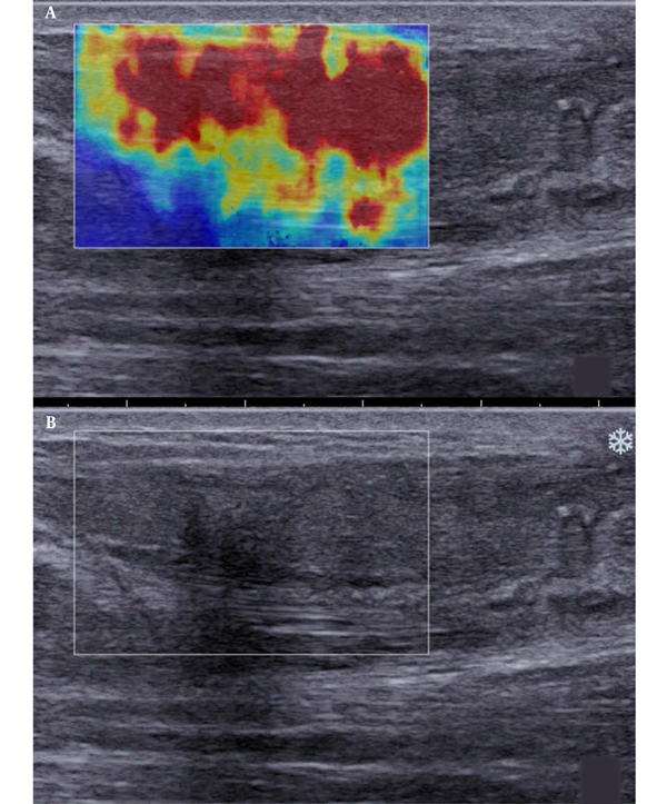 Longitudinal scans of a ruptured Achilles tendon at three months after surgery. A, The shear wave elastography (SWE) image is composed of large red sheets and small blue and yellow segments. B, B-mode sonography shows that the tendon echostructure is heterogeneous.