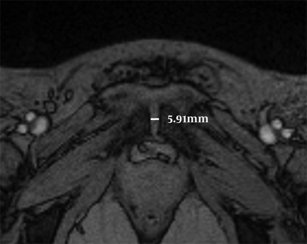 The pubic gap was measured on TE = 11.83 ms images of one woman during her first pregnancy (28 years old, gestational age 35 weeks), the pubic symphyseal width was 5.91 mm.