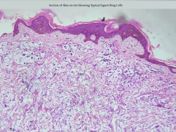 A skin section at 10x, presenting signet ring cells typically with flat compressed nucleus