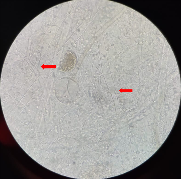 The KOH mount of nasal crusts showing non-septate hyaline fungal hyphae (the red arrow)