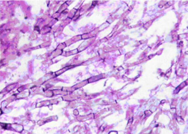 Microphotograph of mass, showing branched septate hyphae indicative of Aspergillosis.
