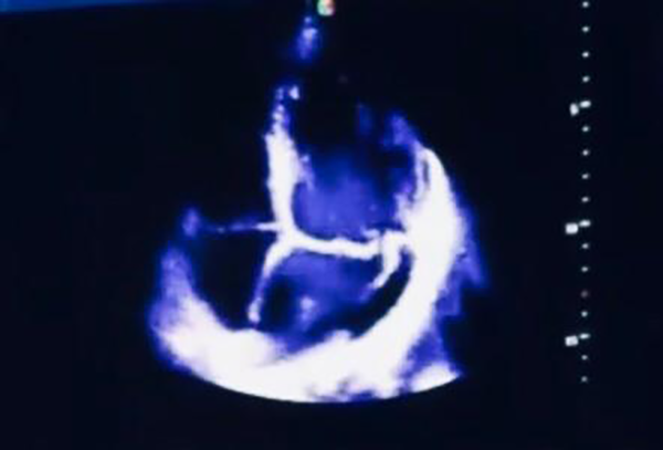 Flail of posterior mitral valve leaflet in trans-thoracic echocardiography