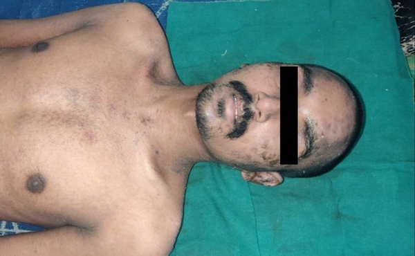 Post-treatment clinical photograph of case 1, showing complete resolution of a rash over face, trunk, and upper limbs.