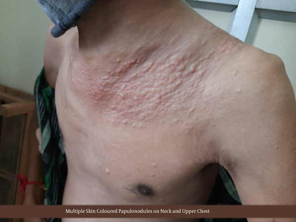 Multiple flesh-colored asymptomatic nodules on neck and upper chest